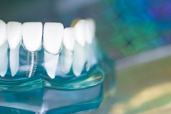 Teeth Replacement    : Dental Implants