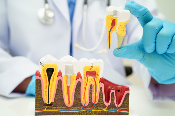 Complications To Watch For After A Tooth Extraction